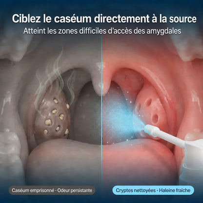 Spray Anti-Caséum pour Amygdales – Haleine Fraîche
