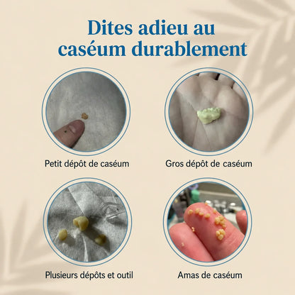 Spray Anti-Caséum pour Amygdales – Haleine Fraîche