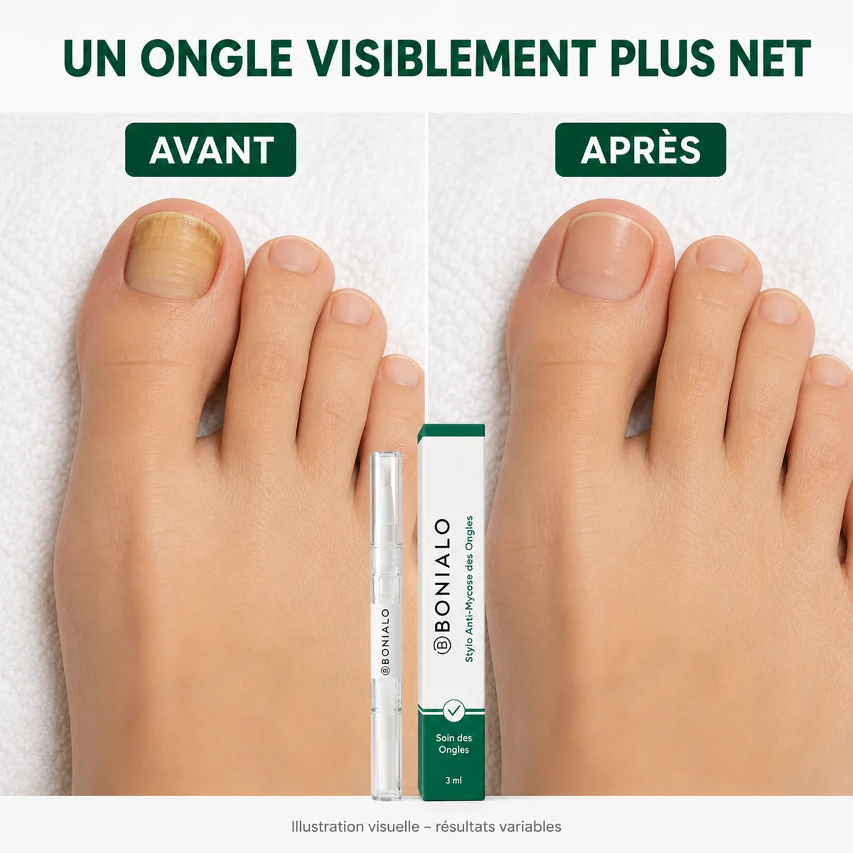 Stylo Anti-Mycose des Ongles
