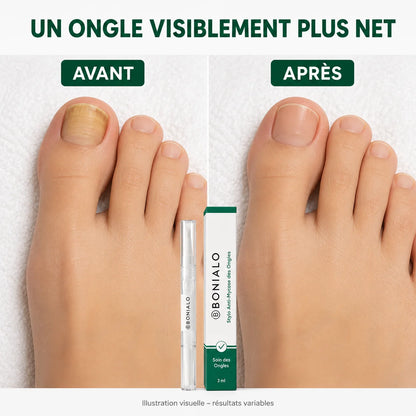 Stylo Anti-Mycose des Ongles